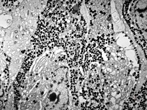 F, 57y. | acromegaly - acidophilic pituitary adenoma (STH) F, 57y. | acromegaly - acidophilic pituitary adenoma (STH)